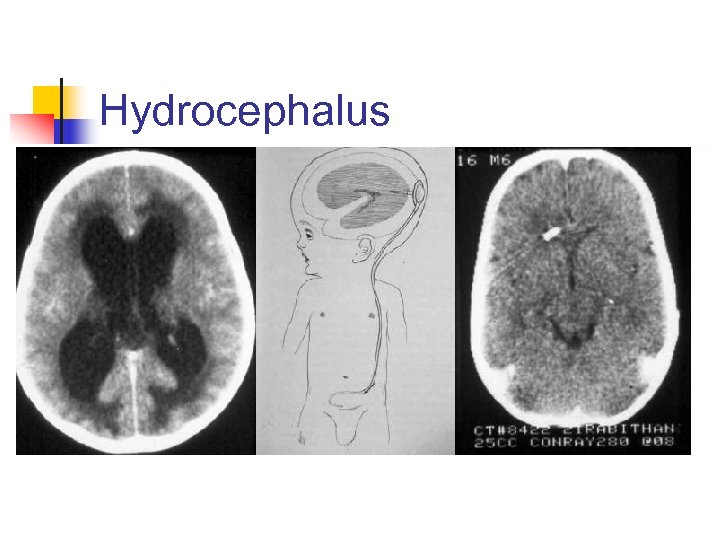 Hydrocephalus 