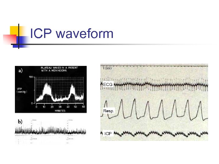 ICP waveform 