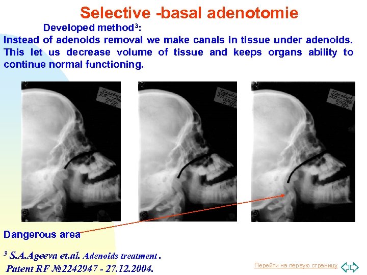 Selective -basal adenotomie Developed method 3: Instead of adenoids removal we make canals in