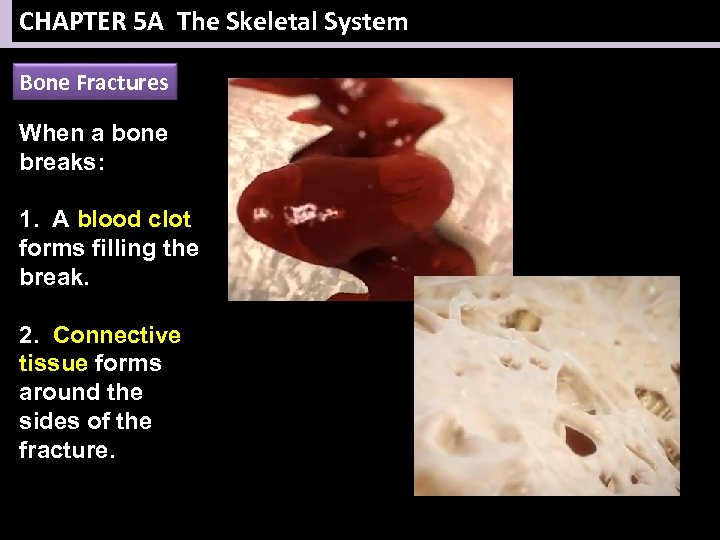 CHAPTER 5 A The Skeletal System Bone Fractures When a bone breaks: 1. A