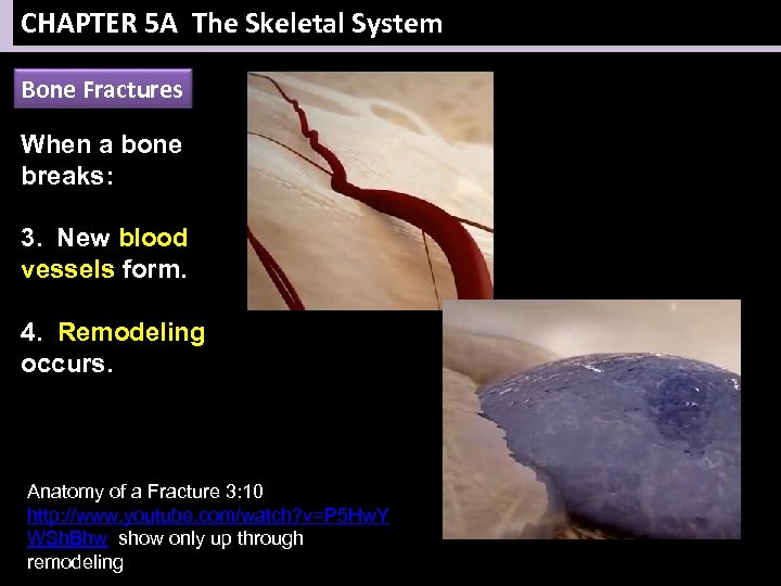 CHAPTER 5 A The Skeletal System Bone Fractures When a bone breaks: 3. New