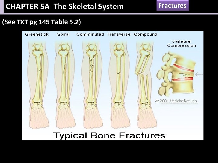 CHAPTER 5 A The Skeletal System (See TXT pg 145 Table 5. 2) Fractures