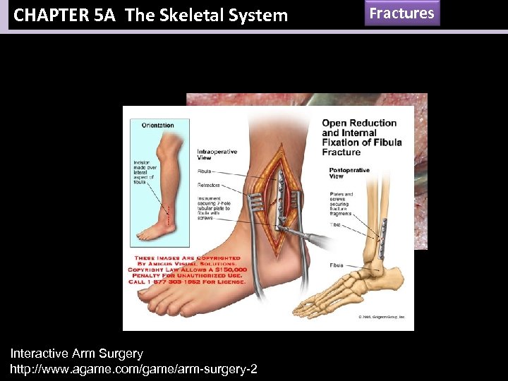 CHAPTER 5 A The Skeletal System Interactive Arm Surgery http: //www. agame. com/game/arm-surgery-2 Fractures