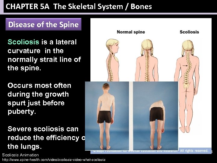 CHAPTER 5 A The Skeletal System / Bones Disease of the Spine Scoliosis is