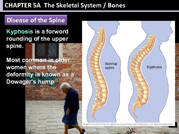 CHAPTER 5 A The Skeletal System / Bones Disease of the Spine Kyphosis is
