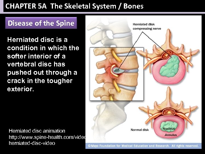 CHAPTER 5 A The Skeletal System / Bones Disease of the Spine Herniated disc
