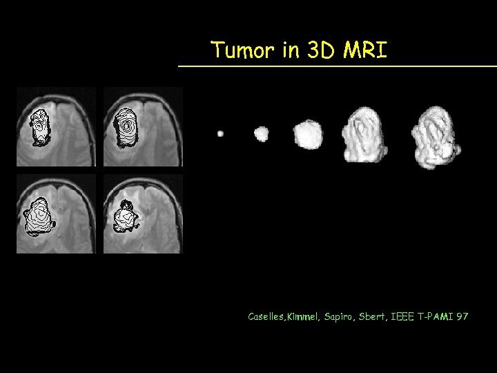 Tumor in 3 D MRI Caselles, Kimmel, Sapiro, Sbert, IEEE T-PAMI 97 