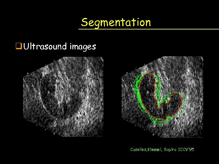 Segmentation q Ultrasound images Caselles, Kimmel, Sapiro ICCV’ 95 