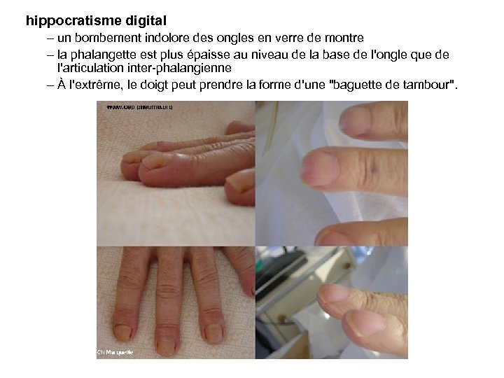 hippocratisme digital – un bombement indolore des ongles en verre de montre – la