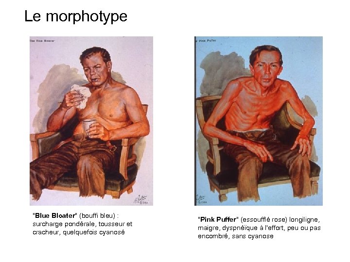 Le morphotype "Blue Bloater" (bouffi bleu) : surcharge pondérale, tousseur et cracheur, quelquefois cyanosé