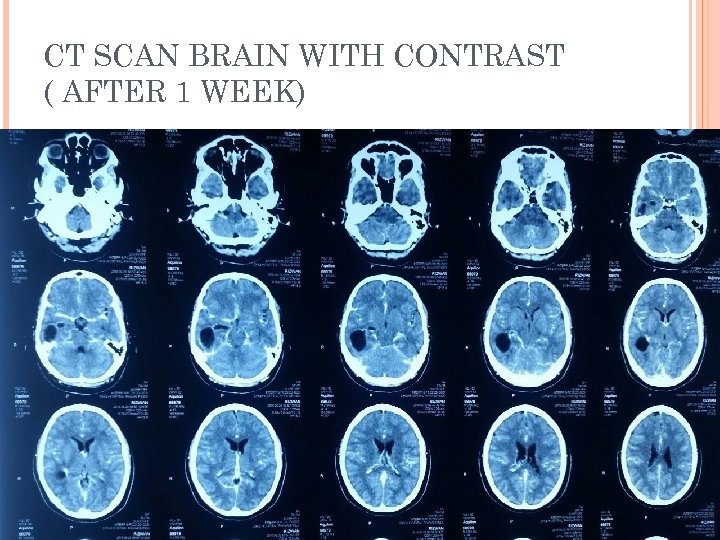 CT SCAN BRAIN WITH CONTRAST ( AFTER 1 WEEK) 