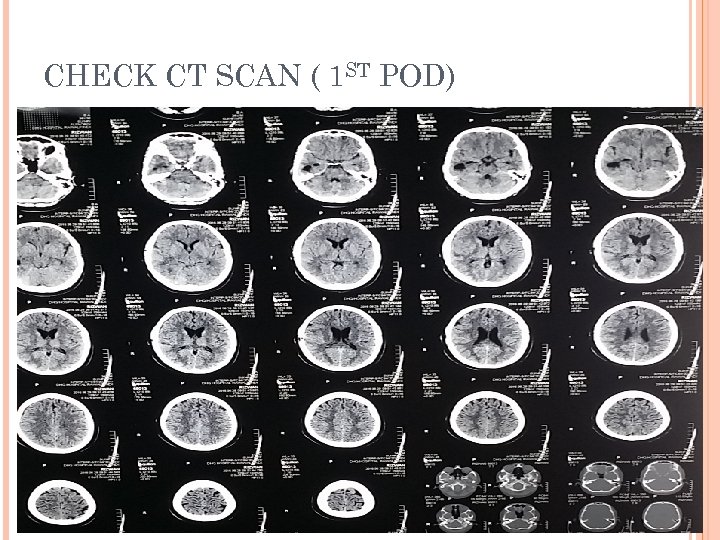 CHECK CT SCAN ( 1 ST POD) 