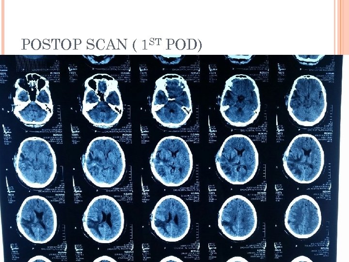 POSTOP SCAN ( 1 ST POD) 