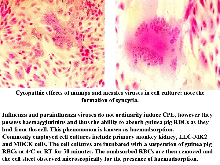  Cytopathic effects of mumps and measles viruses in cell culture: note the formation