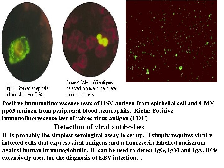  Positive immunofluorescense tests of HSV antigen from epithelial cell and CMV pp 65