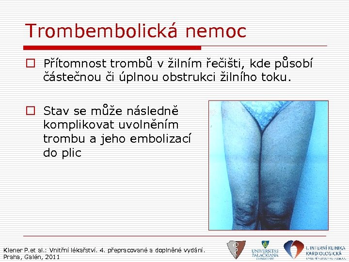 Trombembolická nemoc o Přítomnost trombů v žilním řečišti, kde působí částečnou či úplnou obstrukci