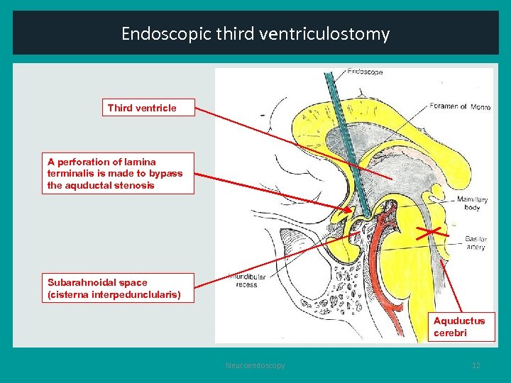 Endoscopic third ventriculostomy Third ventricle A perforation of lamina terminalis is made to bypass