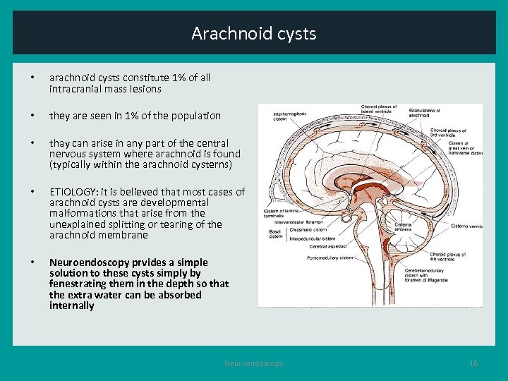 Arachnoid cysts • arachnoid cysts constitute 1% of all intracranial mass lesions • they