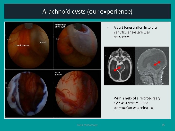 Arachnoid cysts (our experience) • • Neuroendoscopy A cyst fenestration into the ventricular system