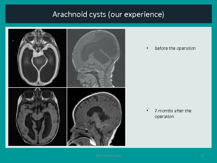 Arachnoid cysts (our experience) • • Neuroendoscopy Before the operation 7 months after the