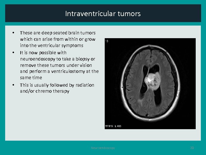 Intraventricular tumors • • • These are deep seated brain tumors which can arise