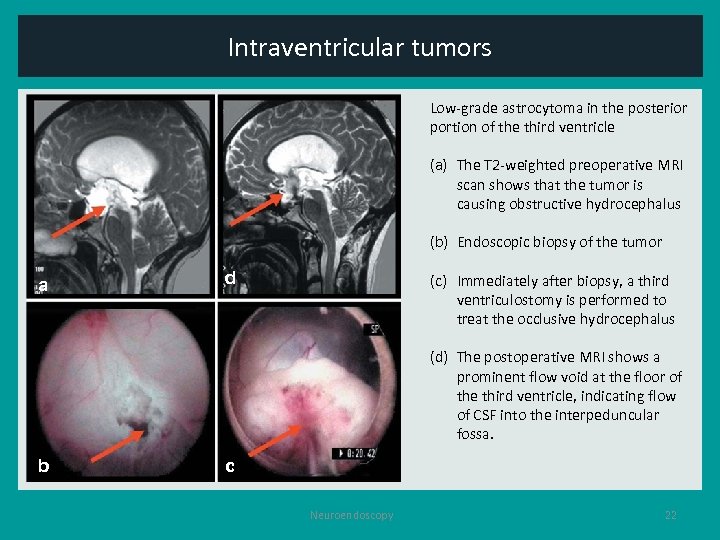 Intraventricular tumors Low-grade astrocytoma in the posterior portion of the third ventricle (a) The