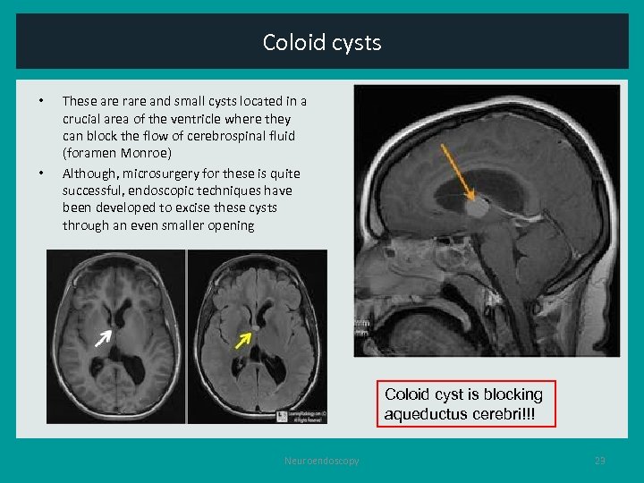 Coloid cysts • • These are rare and small cysts located in a crucial