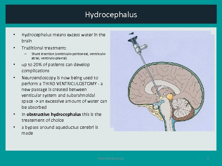 Hydrocephalus • • Hydrocephalus means excess water in the brain Traditional treatment: – •