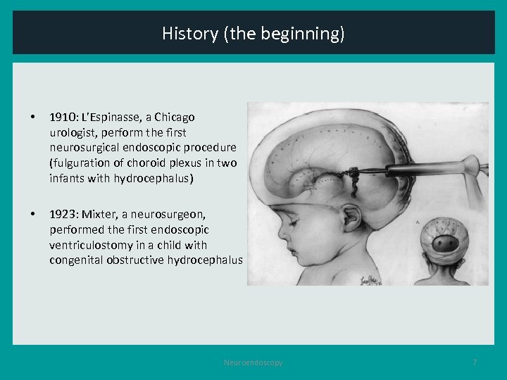 History (the beginning) • 1910: L’Espinasse, a Chicago urologist, perform the first neurosurgical endoscopic