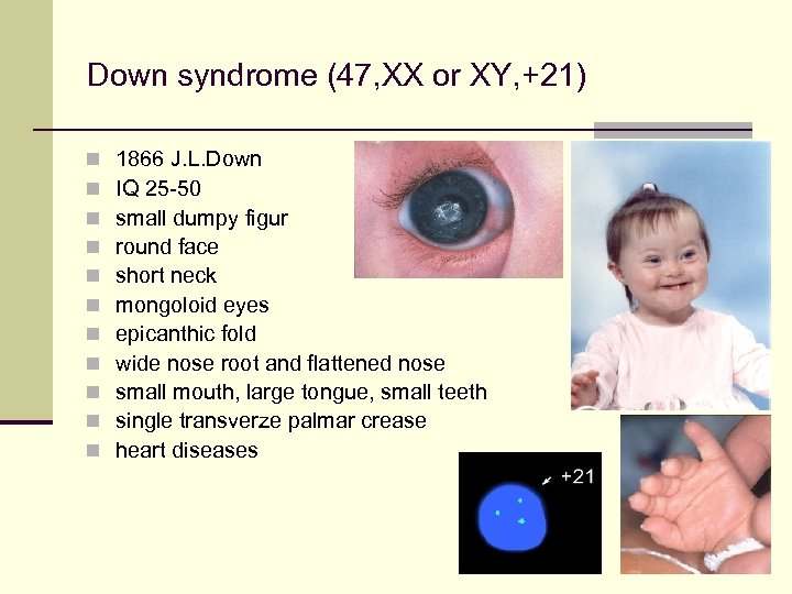 Down syndrome (47, XX or XY, +21) n n n 1866 J. L. Down