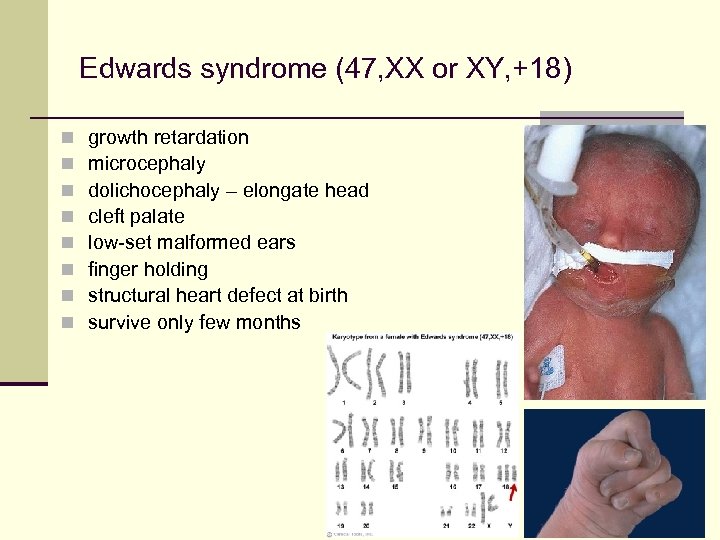 Edwards syndrome (47, XX or XY, +18) n n n n growth retardation microcephaly