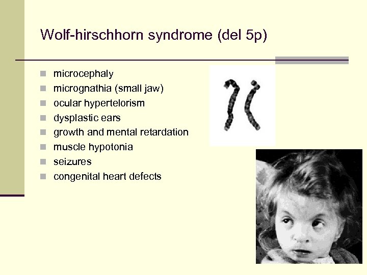 Wolf-hirschhorn syndrome (del 5 p) n microcephaly n micrognathia (small jaw) n ocular hypertelorism