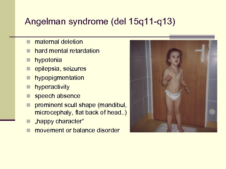 Angelman syndrome (del 15 q 11 -q 13) n maternal deletion n hard mental