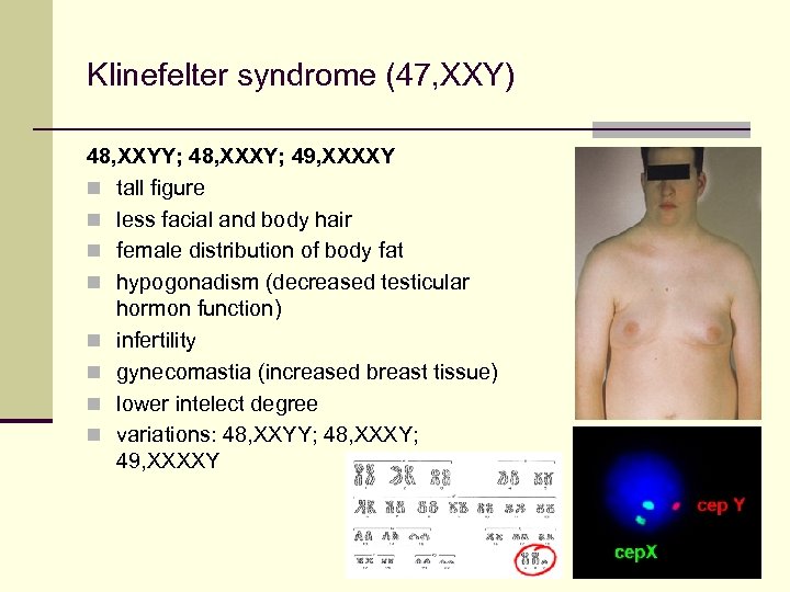 Klinefelter syndrome (47, XXY) 48, XXYY; 48, XXXY; 49, XXXXY n tall figure n