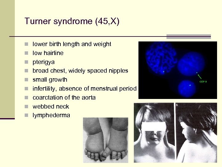 Turner syndrome (45, X) n lower birth length and weight n low hairline n