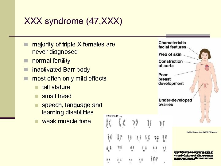 XXX syndrome (47, XXX) n majority of triple X females are never diagnosed n