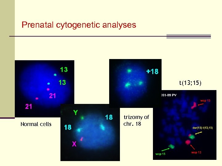 Prenatal cytogenetic analyses t(13; 15) Normal cells trizomy of chr. 18 