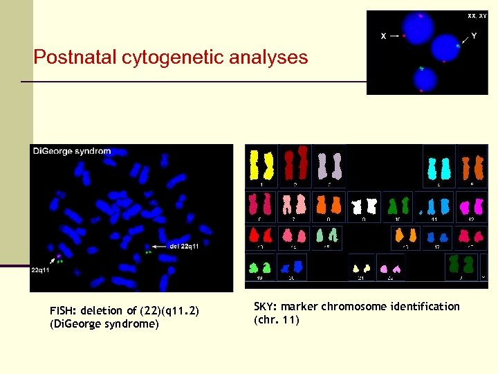 Postnatal cytogenetic analyses FISH: deletion of (22)(q 11. 2) (Di. George syndrome) SKY: marker