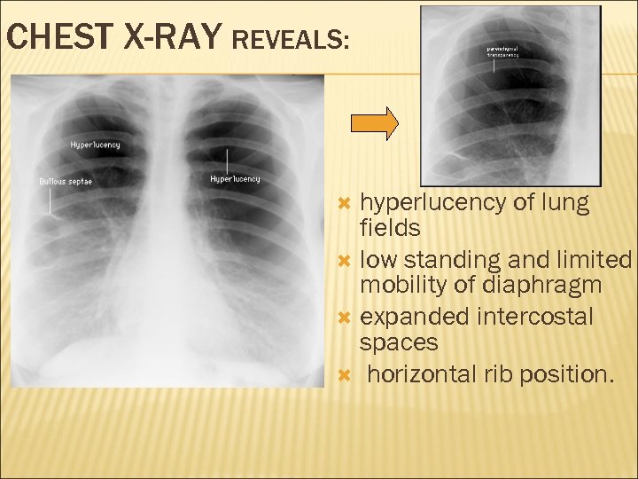 CHEST X-RAY REVEALS: hyperlucency of lung fields low standing and limited mobility of diaphragm