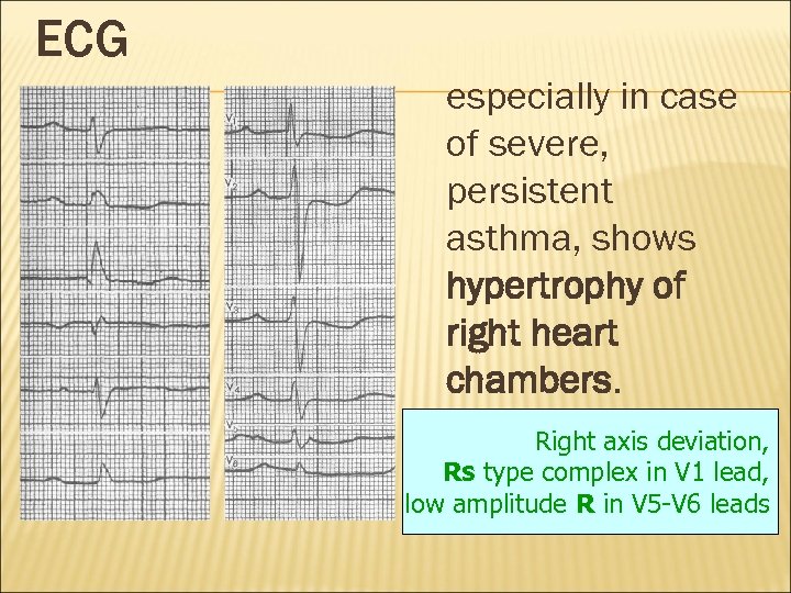 ECG especially in case of severe, persistent asthma, shows hypertrophy of right heart chambers.