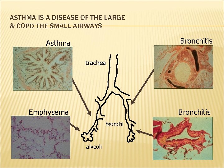 ASTHMA IS A DISEASE OF THE LARGE & COPD THE SMALL AIRWAYS Bronchitis Asthma