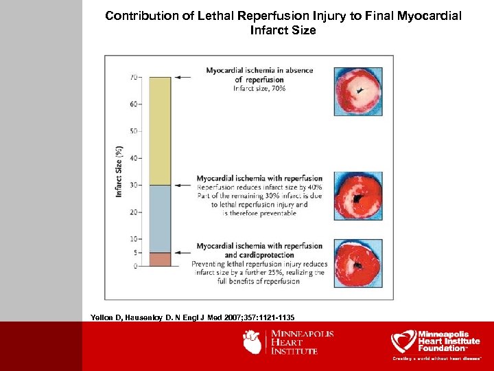 Contribution of Lethal Reperfusion Injury to Final Myocardial Infarct Size Yellon D, Hausenloy D.