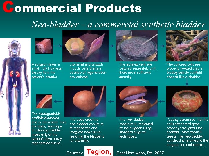 Commercial Products Neo-bladder – a commercial synthetic bladder A surgeon takes a small, full-thickness