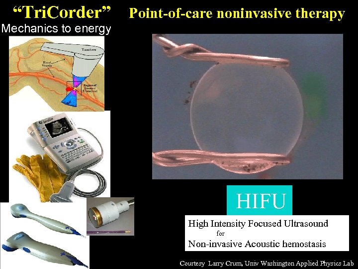 “Tri. Corder” Point-of-care noninvasive therapy Mechanics to energy HIFU High Intensity Focused Ultrasound for