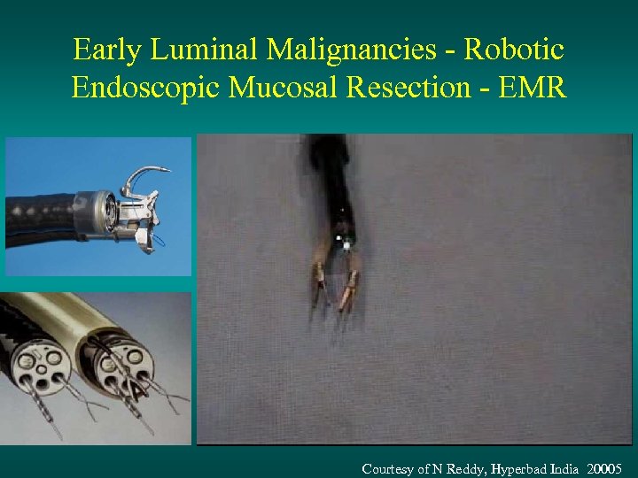 Early Luminal Malignancies - Robotic Endoscopic Mucosal Resection - EMR Courtesy of N Reddy,