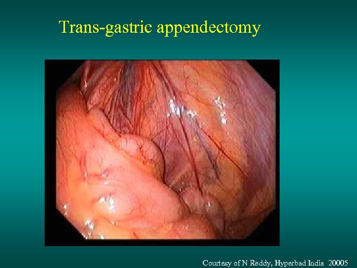 Trans-gastric appendectomy Courtesy of N Reddy, Hyperbad India 20005 