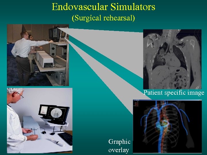 Endovascular Simulators (Surgical rehearsal) Patient specific image Graphic overlay 