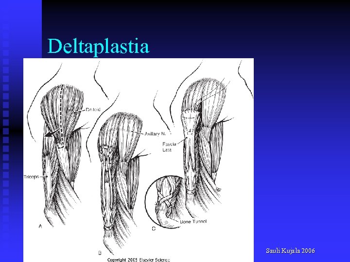 Deltaplastia Sauli Kujala 2006 