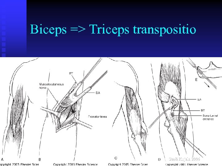 Biceps => Triceps transpositio Sauli Kujala 2006 
