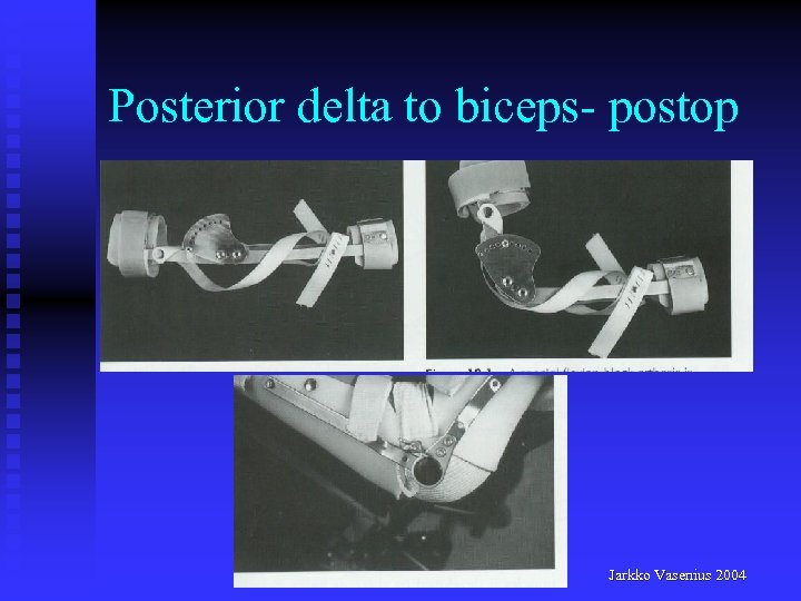 Posterior delta to biceps- postop Jarkko Vasenius 2004 